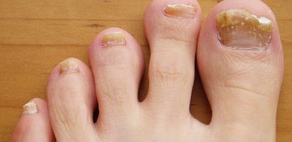 Toenail Fungus – Causes, Treatment and Prevention